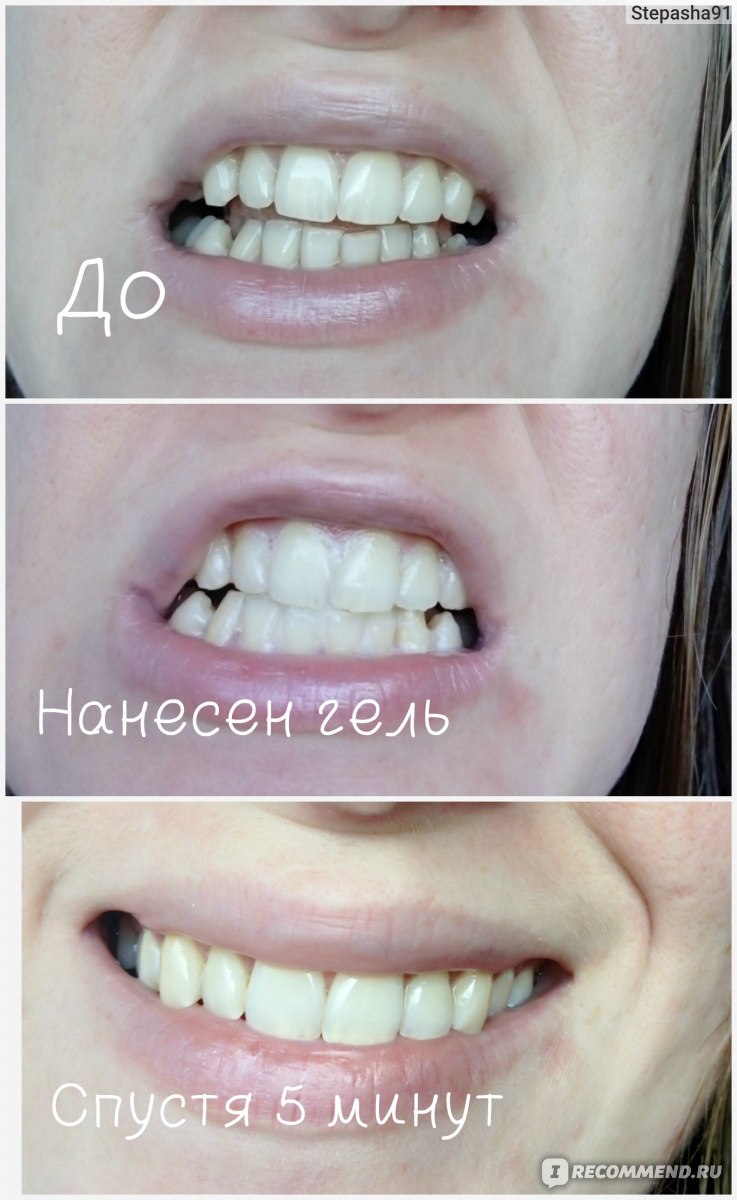 косметическое отбеливание зубов сколько держится