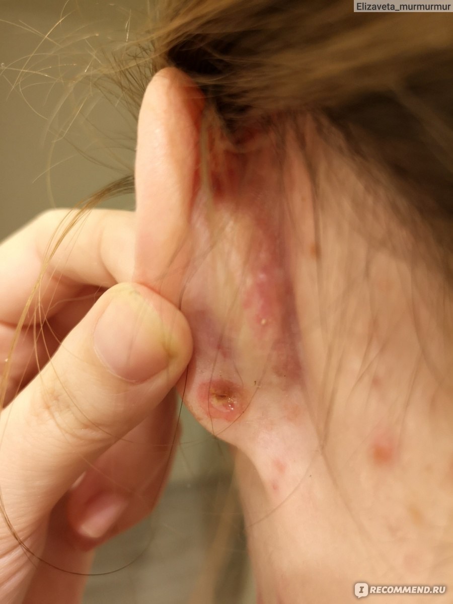 Почему от бижутерии болят уши и что делать