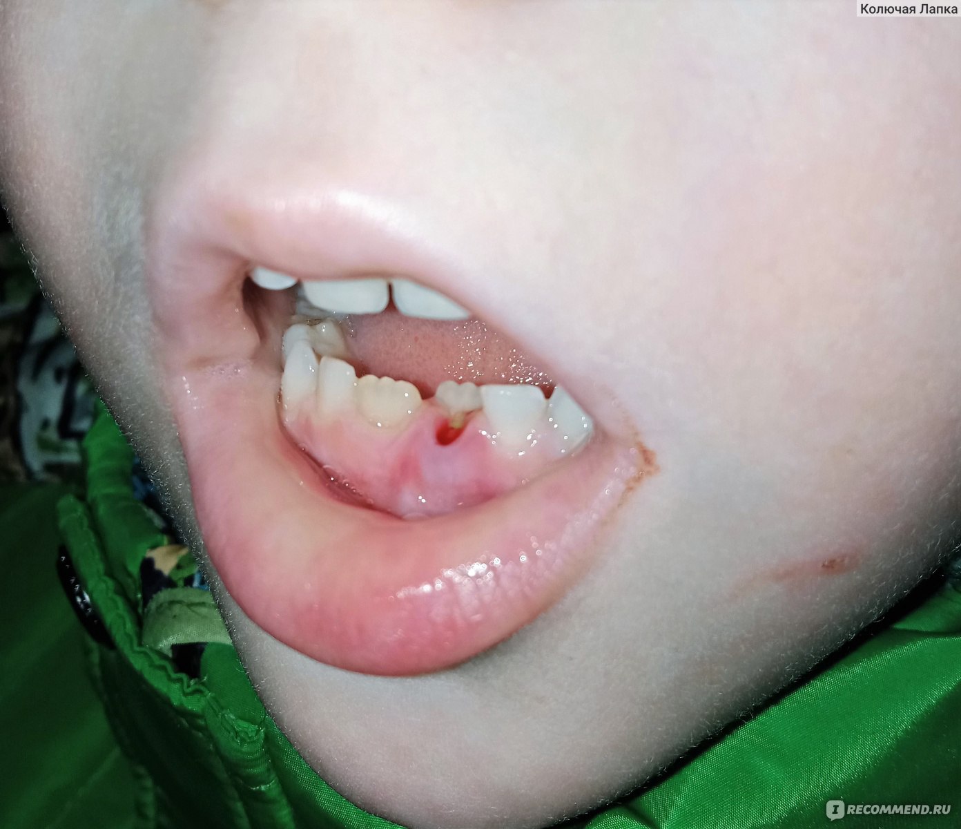 Вашему ребенку удалили зуб. Что важно?
