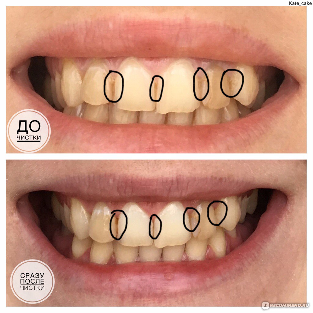 Белые пятна на зубах: почему появляются, как убрать