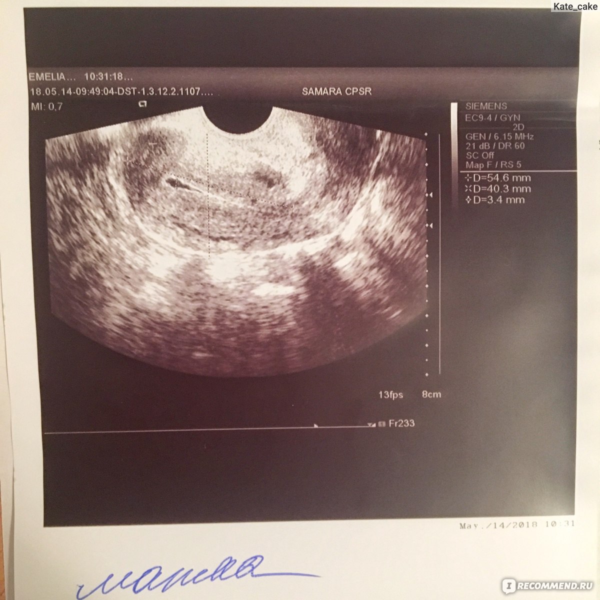 Когда на узи видно беременность на ранних. Снимки УЗИ на ранних сроках. Трансвагинальное УЗИ беременность.