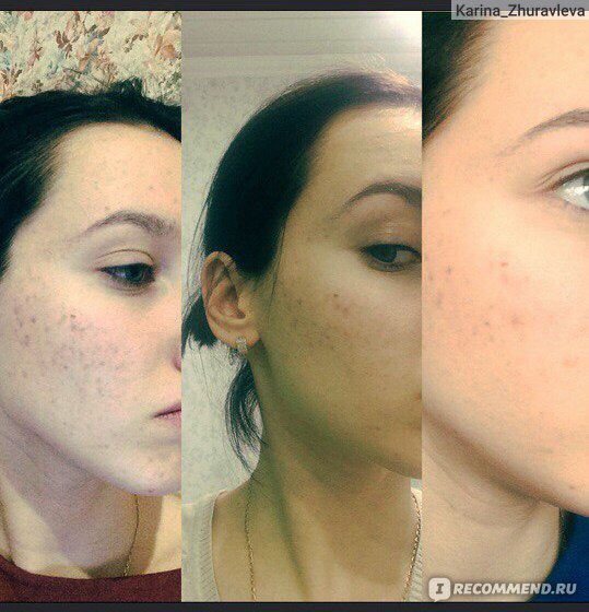 сухой шампунь эффект до и после. дегтярное мыло для лица до и после. волосы после дегтярного шампуня. дегтярное мыло для волос до и после. дпо ощущения.