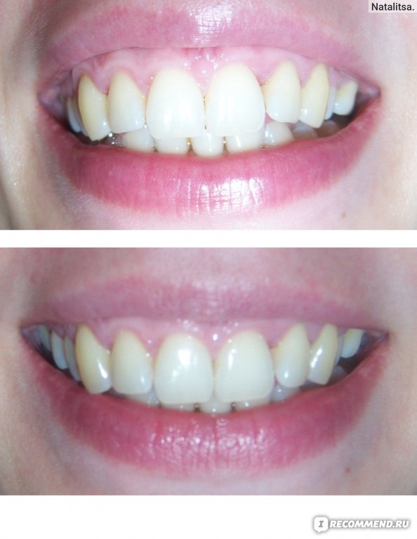 Отбеливание зубов с эфирными маслами ингаляторы инструкция по применению