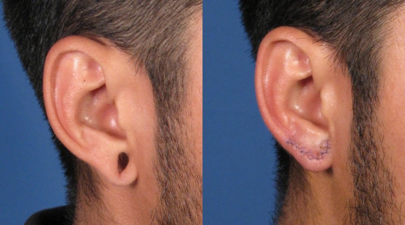 Причины стука в ушах, лечение. Пульсация в ушах