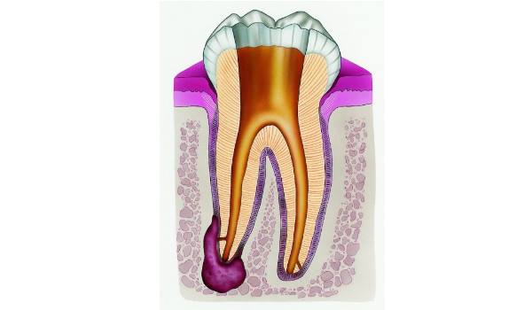 Лечение кисты зуба у стоматолога фото