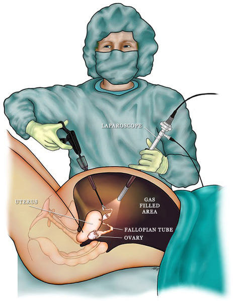 Зачем ставят дренаж после лапароскопии непроходимость маточных труб операция отзывы
