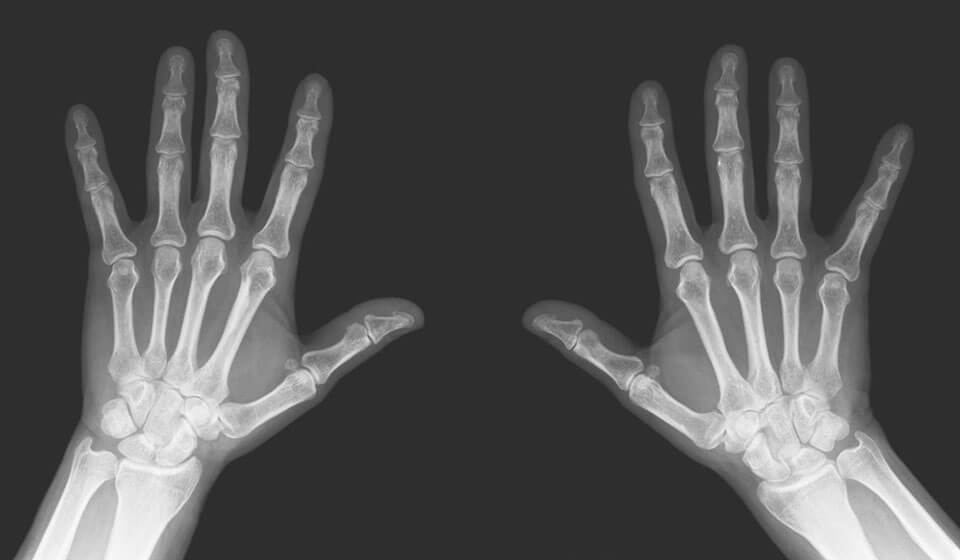 Рентген кисти руки