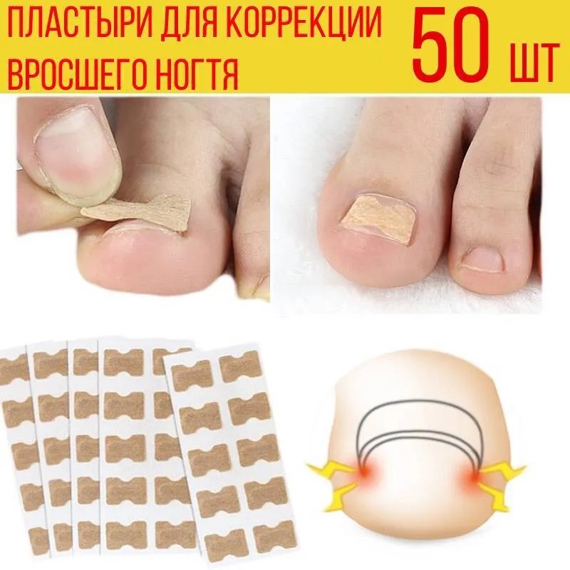 Пластырь Toenail Correction Patch Пластырь наклейка при врастании ...