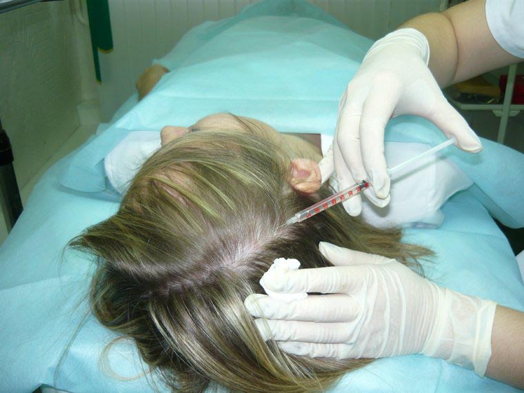 Мезотерапия – Лечение волос