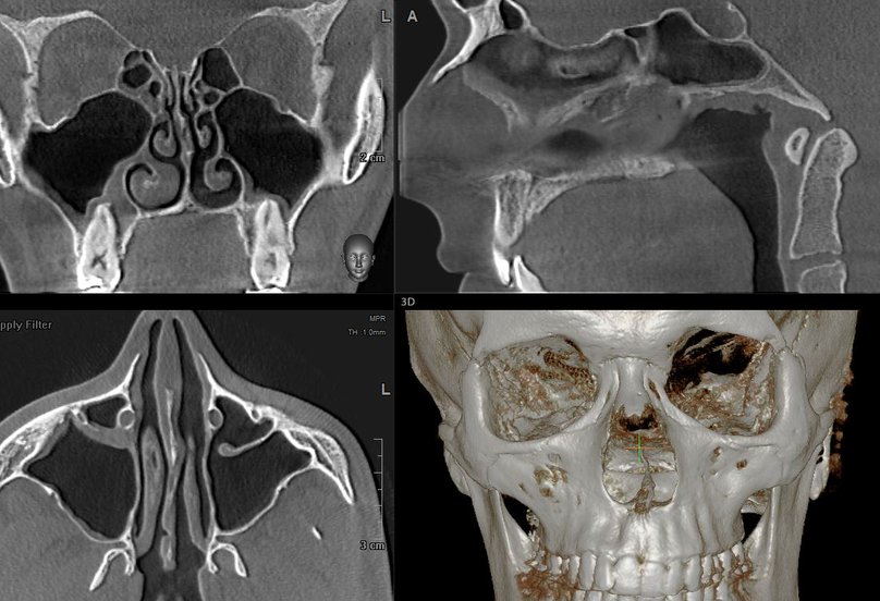 Кт носовых пазух фото