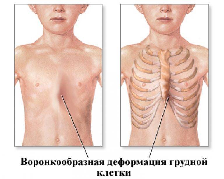 Ладьевидная грудная клетка рисунок