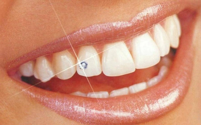 Скайсы на зубы Томск Войлочная томск стоматологии недорогие