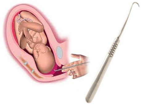 Стимуляция родов в конце или ближе к концу беременности при подозрении на крупный плод (макросомию)