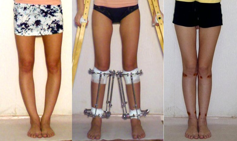 Способы скрыть кривые ноги под одеждой