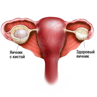 Лечение воспаления яичников, симптомы, чем лечить воспаление яичников у женщин в Москве