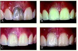 Внутриканальное  отбеливание зубов (Эндоотбеливание) фото